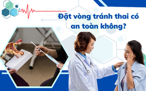 ĐẶT VÒNG TRÁNH THAI CÓ AN TOÀN KHÔNG?